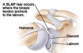 labrum tear shoulder