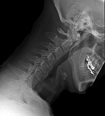 X-ray of a Cervical Spine