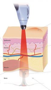 photo of bioflexlaser3